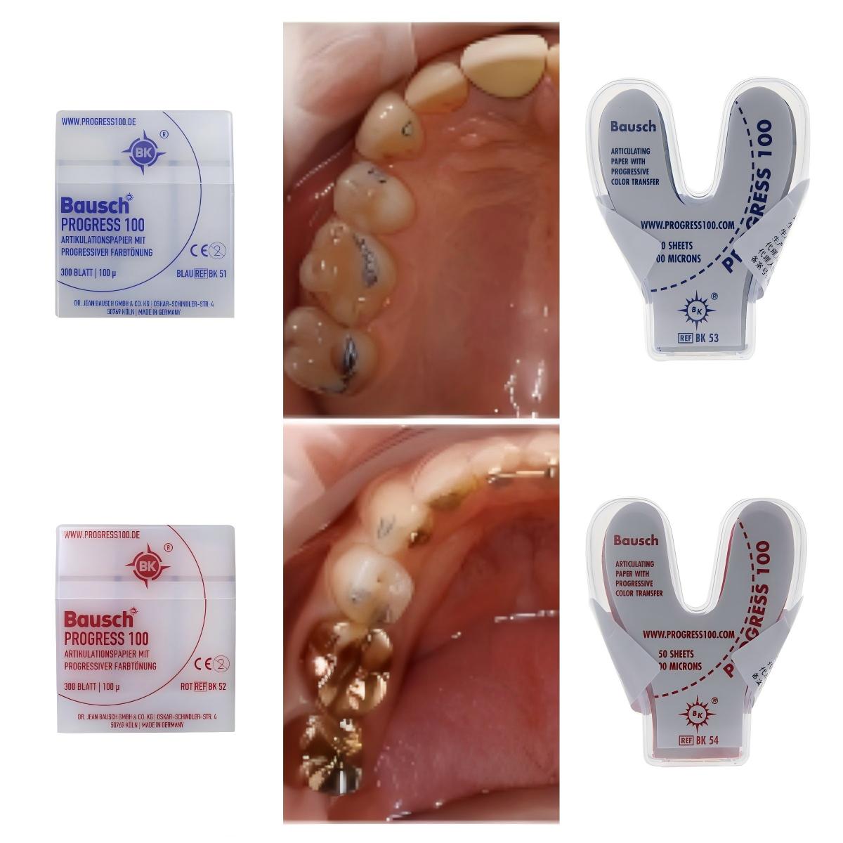 กระดาษบันทึกการกัดฟัน Bausch B - Bite Indicator บทวิจารณ์และราคา
